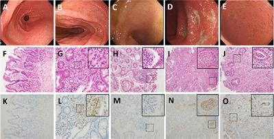 Case Report: Proteinase 3 Antineutrophil Cytoplasmic Antibody-Associated Ulcerative Colitis Presenting as Recurrent Intestinal Pseudo-Obstruction in a Teenage Patient With in situ Proteinase 3 Immunohistochemical Staining